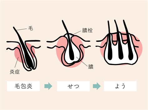 クリトリス ほくろ|陰部にニキビ？ デリケートゾーンの「できもの」の正体